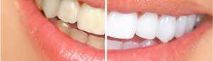 שיטות ומחיר הלבנת שיניים 